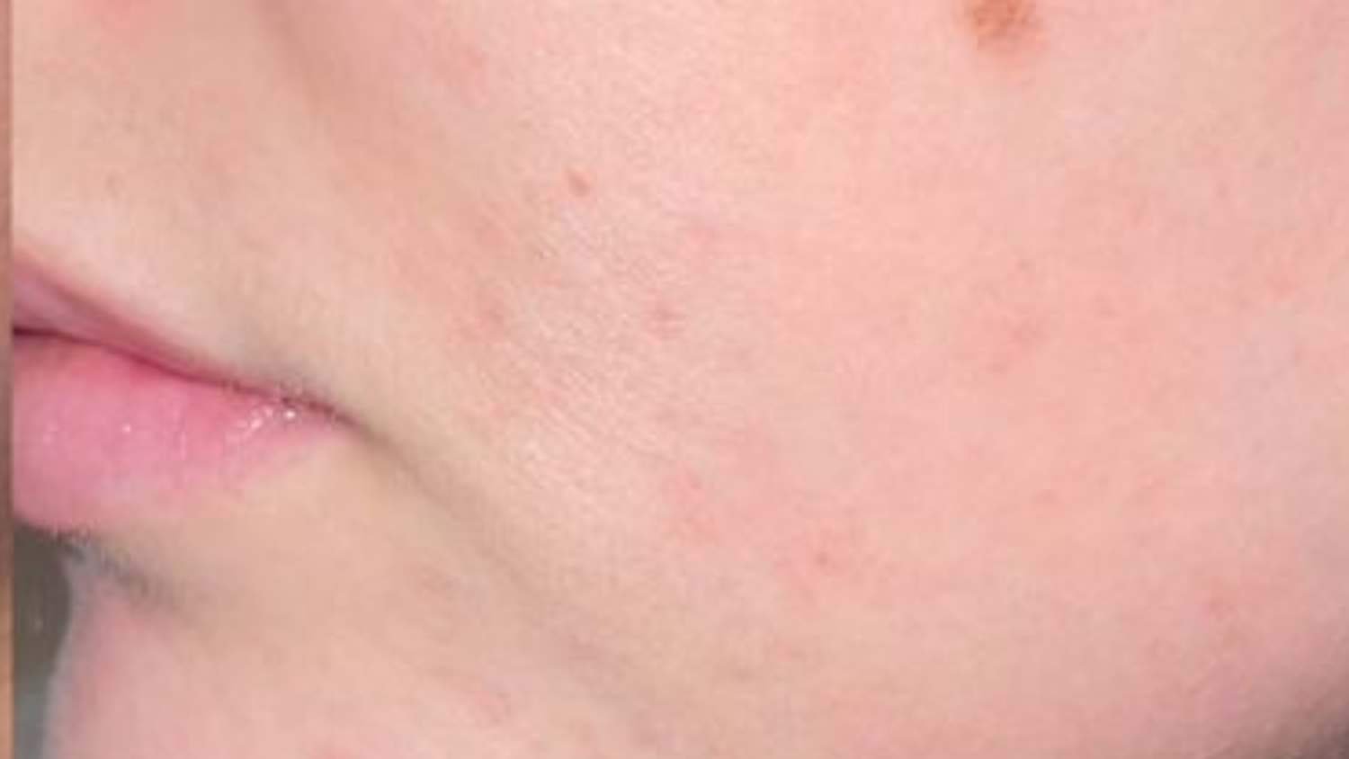 visage sans bouton avec masque naubelle pdrn