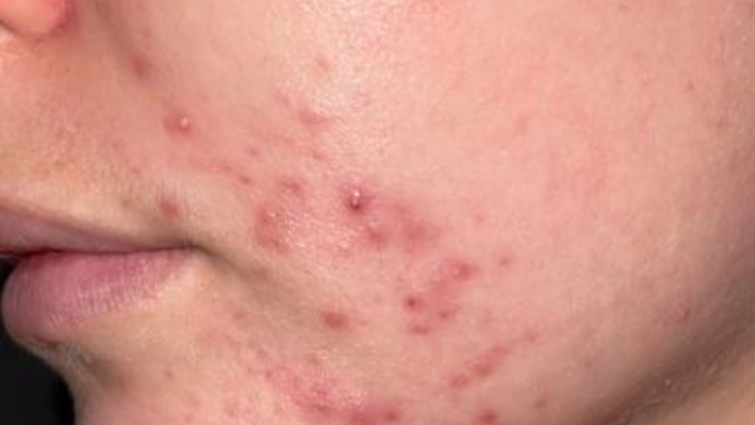 visage bouton sans masque naubelle pdrn